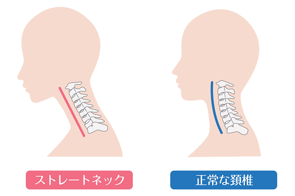 ストレートネックの図